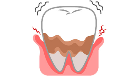 歯周病（歯肉炎、歯周炎）
