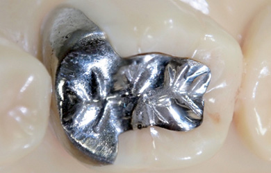 銀歯のメリット・デメリット