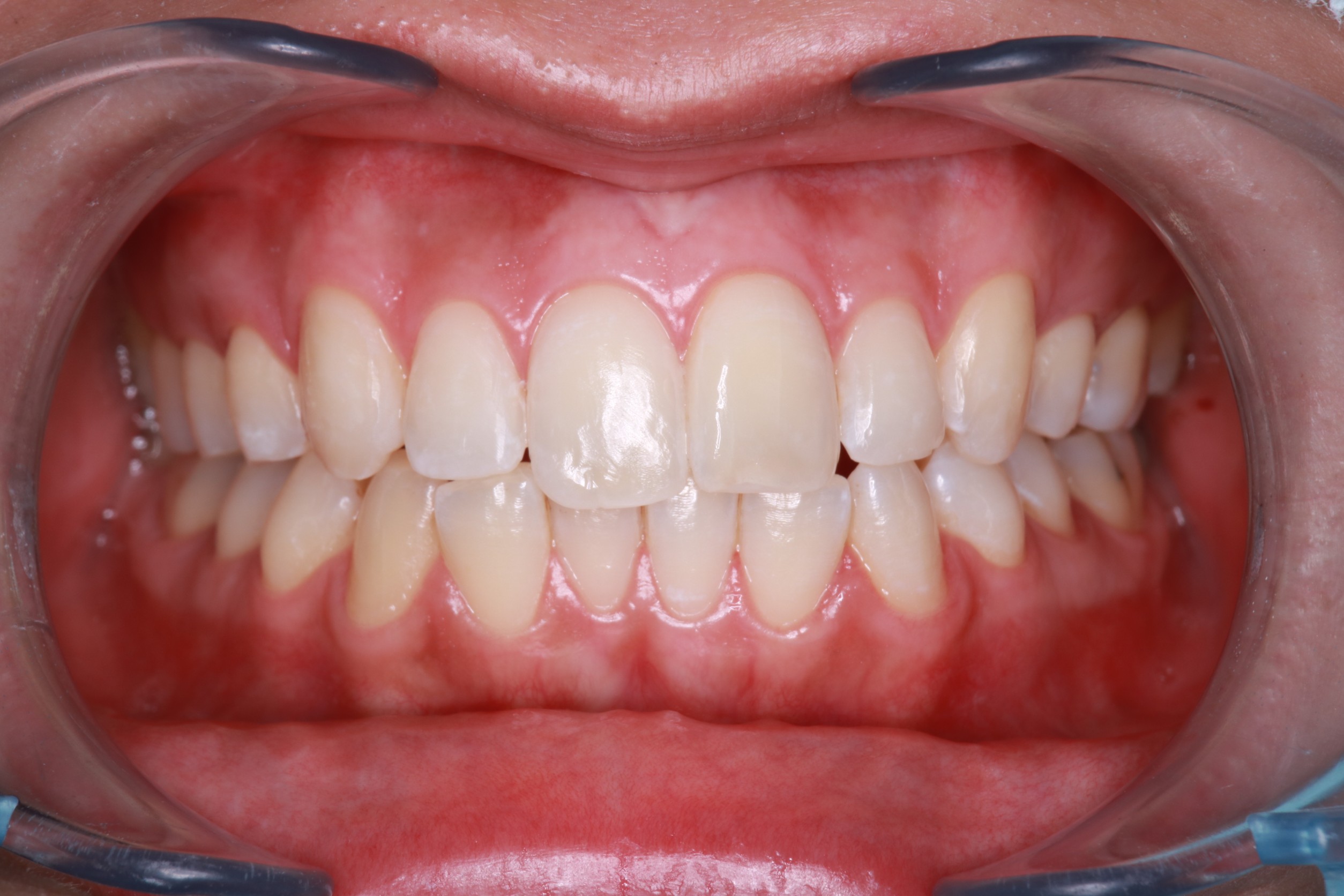 STEP1（上の前歯のみホワイトニング）