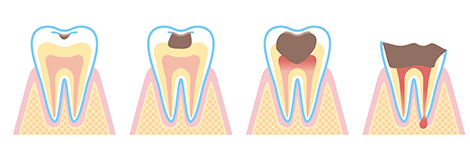 虫歯は早期発見・早期治療が基本